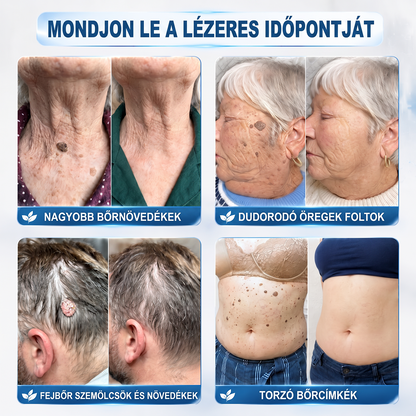 HISKIN®⭐ 7 napos golyós aplikátor szemölcsök és foltok ellen – Fejlett, fájdalommentes és hegmentes bőrhibatartó megoldás