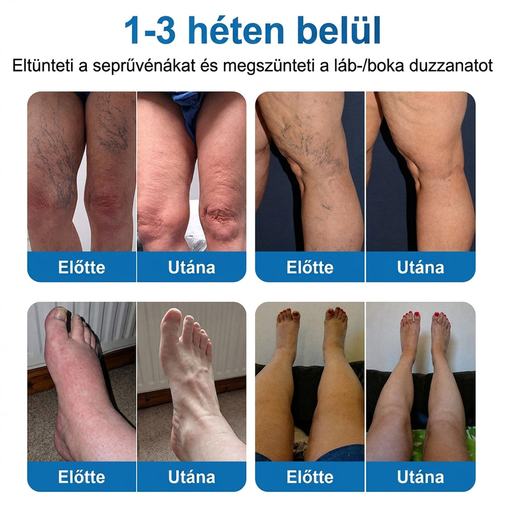 Lexasky® Vénakönnyítő Mikrotűs Ápoló Tapasz 🦶 Gyors Megkönnyebbülés, Tartós Hatás ⏰ MA UTOLSÓ NAP – 80% KEDVEZMÉNY