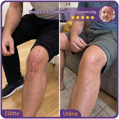PUROSA®🩹 Orvosi tisztaságú szilikon hegápoló görgő (Kiemelkedő, piros, kemény, feszülő és elszíneződött műtéti hegekre)