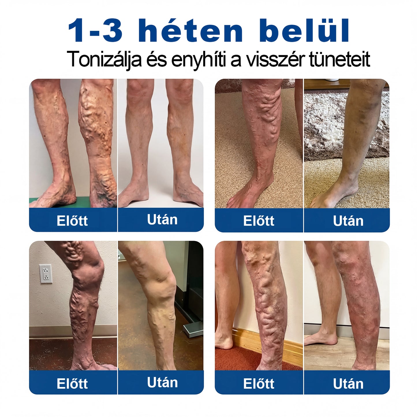 Lexasky® Vénakönnyítő Mikrotűs Ápoló Tapasz 🦶 Gyors Megkönnyebbülés, Tartós Hatás ⏰ MA UTOLSÓ NAP – 80% KEDVEZMÉNY
