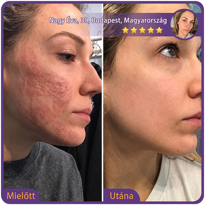 PUROSA®🩹 Orvosi tisztaságú szilikon hegápoló görgő (Kiemelkedő, piros, kemény, feszülő és elszíneződött műtéti hegekre)