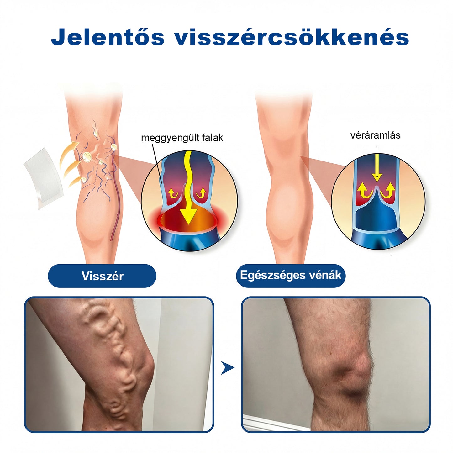 Lexasky® Vénakönnyítő Mikrotűs Ápoló Tapasz 🦶 Gyors Megkönnyebbülés, Tartós Hatás ⏰ MA UTOLSÓ NAP – 80% KEDVEZMÉNY