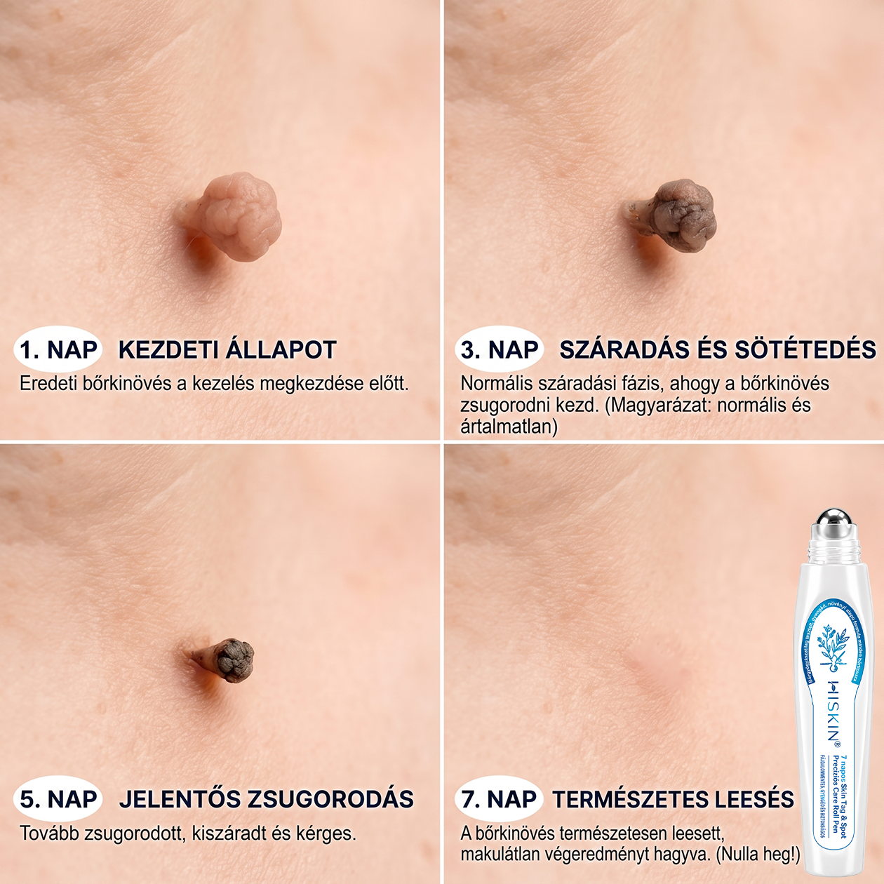 HISKIN®⭐ 7 napos golyós aplikátor szemölcsök és foltok ellen – Fejlett, fájdalommentes és hegmentes bőrhibatartó megoldás
