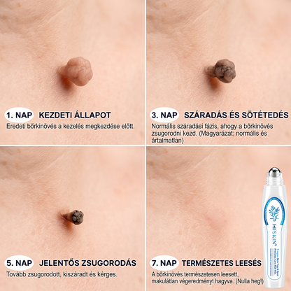 HISKIN®⭐ 7 napos golyós aplikátor szemölcsök és foltok ellen – Fejlett, fájdalommentes és hegmentes bőrhibatartó megoldás