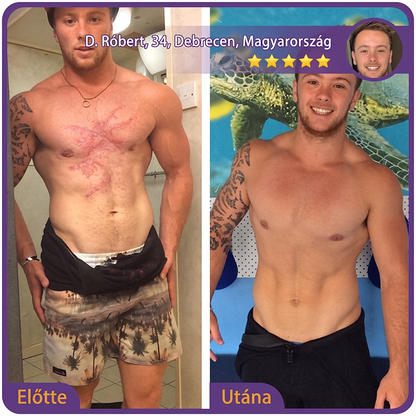 PUROSA®🩹 Orvosi tisztaságú szilikon hegápoló görgő (Kiemelkedő, piros, kemény, feszülő és elszíneződött műtéti hegekre)