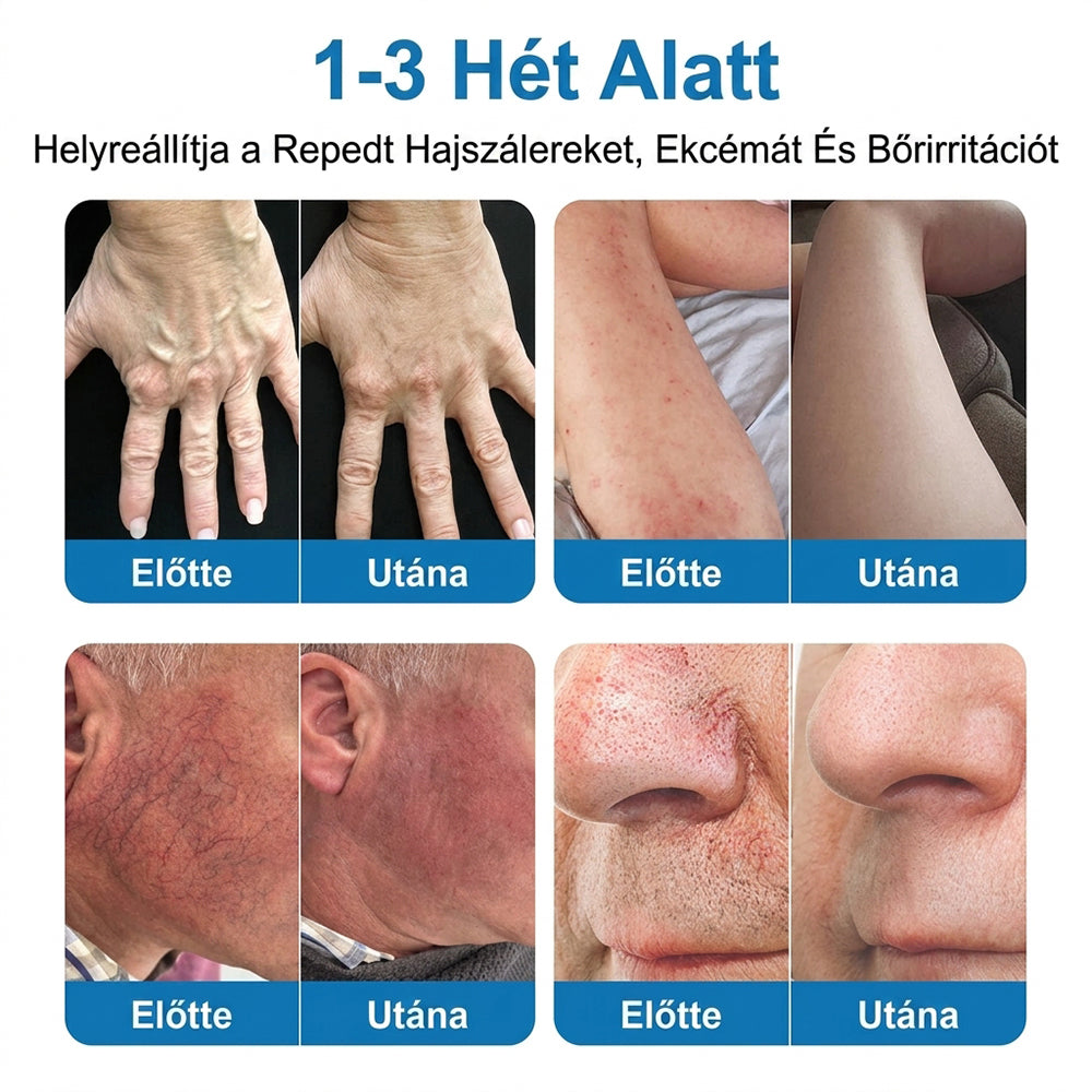Lexasky® Vénakönnyítő Mikrotűs Ápoló Tapasz 🦶 Gyors Megkönnyebbülés, Tartós Hatás ⏰ MA UTOLSÓ NAP – 80% KEDVEZMÉNY