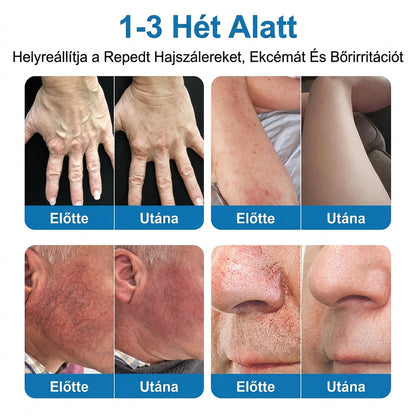 Lexasky® Vénakönnyítő Mikrotűs Ápoló Tapasz 🦶 Gyors Megkönnyebbülés, Tartós Hatás ⏰ MA UTOLSÓ NAP – 80% KEDVEZMÉNY
